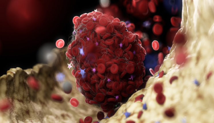 دراسة جديدة: مشروب شائع يقلل من تكوّن جلطات الدم وخطر السكتات الدماغية!